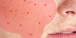 Ein vermehrtes auftreten wird bei hellem hauttyp und positiver familienanamnese verzeichnet. How To Tell If Your Acne Might Actually Be Rosacea Self