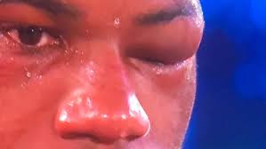 But he is also stiff, slow footed and was absolutely gassed in the corner i think dianabol dubois has his place in the division. Boxing News 2020 Daniel Dubois Injury Vs Joe Joyce Quit