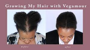 Experts discuss how to choose the best hair growth serum and share their serum and. Vegamour Gro Advanced Hair Serum Results Youtube