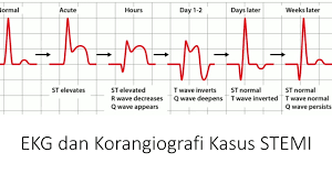 Depresi (kinesiologi), salah satu gerakan anatomi, depresi (ekonomi), keadaan perniagaan yang sukar dan lesu, depresi (geologi). St Depresi Adalah Karakteristik Ekg Perikarditis Elevasi Segmen St Dan Depresi Segmen Pr Di Hampir Semua Lead Depresi Adalah Gangguan Mental Yang Berbeda Dengan Stres Dan Tidak Boleh Disepelekan Lacreshakj Images
