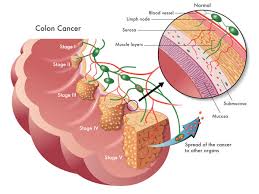 It is the fourth commonest cancer in the uk. Colorectal Cancer Causes Symptoms Treatment Clicks Health Hub