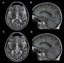 Image result for Thalamotomy