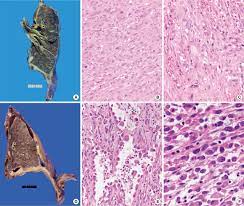 Malignant mesothelioma is a disease in which malignant cells are found in the pleura (the thin layer of tissue that lines the chest cavity and covers the lungs) or the peritoneum (the thin layer of tissue that lines the abdomen and covers most of the organs in the abdomen). Journal Of Pathology And Translational Medicine