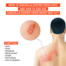 Image result for Varicella zoster on human skin