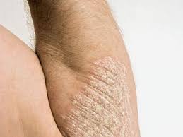 Image result for psoriasis