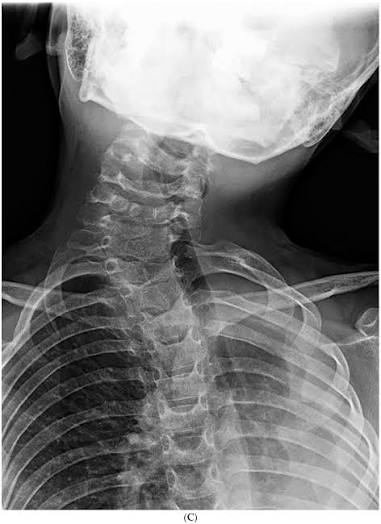 Risk Factors for Progression of Cervical Congenital Scoliosis and  Associated Compensatory Curve Behavior