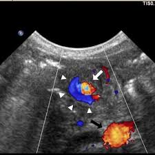 Image result for Midgut Volvulus