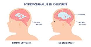Image result for Hydrocephalus