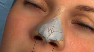 Iphone facetouchup is the premier tool for visualizing plastic surgery results. Rhinoplasty Animation American Society Of Plastic Surgeons
