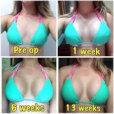 How long does it take for breast implants to drop. Pin On Breast Implants