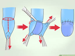 Image result for Phimosis