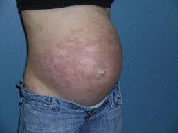 Image result for pruritic urticarial papules and plaques of pregnancy