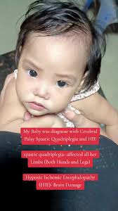 Cerebral Palsy Kids with Right Side Hemiplegia