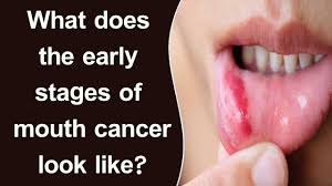 See mouth cancer pictures to learn what common mouth cancer sores on the tongue, gums, and cheek look like. What Does The Early Stages Of Mouth Cancer Look Like Youtube