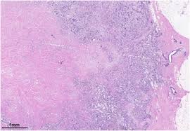 3 getting a diagnosis and treatment. Pathological Characterisation Of Male Breast Cancer Results Of The Eortc 10085 Tbcrc Big Nabcg International Male Breast Cancer Program Sciencedirect