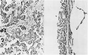 Risk estimates and whither electron microscopy for diagnosis? References In Diffuse Epithelial Pleural Mesothelioma Presenting As A Solitary Lung Mass Chest