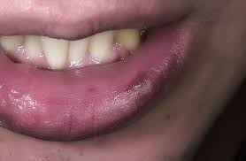 Osmeh devojčice koja nije mogla da jede i govori (video) 16/12/16 | 15:49 hemangiom je dobroćudni tumor koji se formira stvaranjem prevelikog broja krvnih sudova ispod površine kože Pigmentacijske Usne Sta Uciniti Pigmentne Mrlje Na Usana