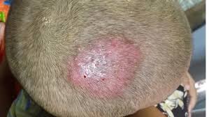 Image result for Tinea Capitis