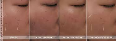 Back acne, or bacne, occurs when skin on the back breaks out with blackheads and pimples. How To Remove Acne Scars In One Week