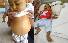 Check spelling or type a new query. Idap Kolestasis Warna Tubuh Kuning Feses Putih Biaya Operasi Rp 2 M