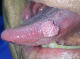 Sansa de supravietuire este cu atat mai crescuta cu cat cancerul a fost depistat mai devreme. O Que E Bom Para Verme Oxiurus O Que E Bom Para Matar Oxiurus