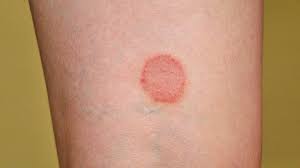 It is usually red or dark and may be itchy and sometimes smelly. Is That Rash Psoriasis Psoriasis Pictures And More Everyday Health