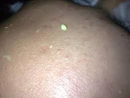Apa yang anda perlu tahu, jika petua ini bersesuaian dengan anda, tak sampai lima minit, ulat resdung akan keluar melalui kulit muka. Ulat Resdung