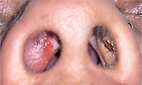 It may occur after a cold, with wiping the nose excessively or by vigorous nose picking. Jaypeedigital Ebook Reader