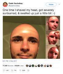 Guy S Hilariously Tragic Story Of How He Got A Head Dent Serves As A Great Reminder To Always Use Sunscreen Fail Blog Funny Fails