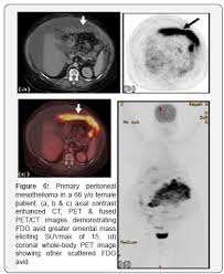 A biopsy is the only definitive way to confirm a mesothelioma diagnosis. The Evolving Role Of 18f Fdg Pet Ct In Assessment Of Primary And Secondary Peritoneal Malignancies