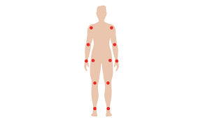 Rheumatoid Arthritis Meijer Speciality Pharmacy
