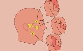 Pseudotumor Cerebri Syndrome Headache Is Often Episodic With