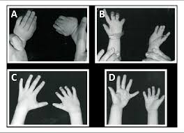 Typically the right side is involved. Figure 5 From Presentation And Treatment Of Poland Anomaly Semantic Scholar