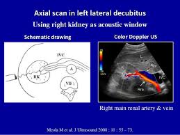 Doppler Ultrasound Of The Kidneys Ultrasound Vascular Ultrasound Ultrasound Sonography