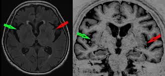 Dr michael firbank discusses his study using functional mri in lewy body dementia and alzheimer's disease at the newcastle university institute. The Insula As A Biomarker Of Dementia With Lewy Bodies On Medicine