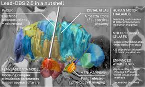 Image result for Thalamic Stimulation