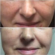 It's usually more painful and takes longer to heal. Sun Damaged Skin Phoenix Tattoo Removal