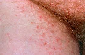 Image result for scabies on genitals