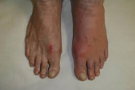Do You Suffer From Painful Gout In Your Toes Fingers Or Other Joints It Doesn T Have To Be That Way Get Rid Of Gout Symptoms Arthritis Arthritis Symptoms