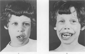 Infantile Hypercalcemia Syndrome in Twins