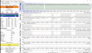 help understanding spo2 assistant charts apnea board