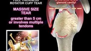 Rotator Cuff Tear Classification Everything You Need To Know Dr Nabil Ebraheim Youtube