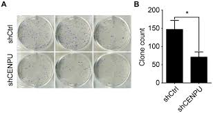 Researchers do not know exactly what causes most bladder cancers. Centromere Protein U Is A Potential Target For Gene Therapy Of Human Bladder Cancer