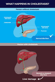 Image result for acholic stools human