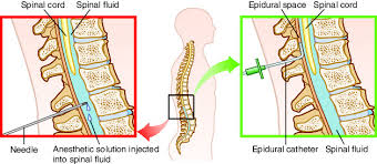 Image result for Intrapleural Anesthesia