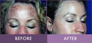 Photodynamic Therapy Treatment In Lititz Randalicentre Com