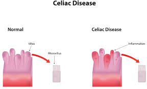 Antibodies to deamidated gliadin peptide in diagnosis of celiac disease in children. Celiac Disease Jackson Siegelbaum Gastroenterology