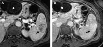 Abdominal Hemangiomas A Pictorial Review Of Unusual Atypical And Rare Types Sciencedirect