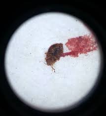 Maybe you would like to learn more about one of these? Bed Bug Bites