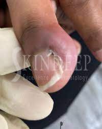 Image result for Paronychia feet